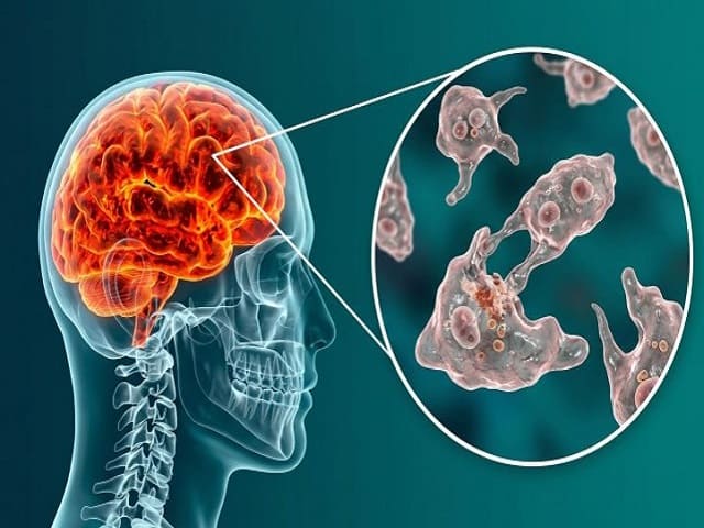 Informan sobre fallecimiento de paciente con diagnóstico probable de ameba “come-cerebros”